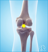 膝の裏側の痛み（膝蓋軟骨軟化症,膝の軟骨損傷,変形性膝関節症）
