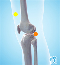 変形性膝関節症の膝の横の痛み