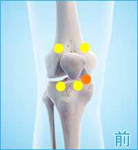 変形性膝関節症　膝の前側の痛み