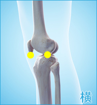 変形性膝関節症の膝の横の痛み