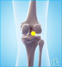 前十字靭帯損傷の膝の後ろ側の痛み