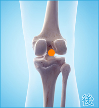 変形性膝関節症の膝の後ろ側の痛み