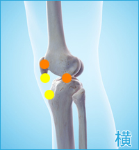 膝の外側の痛み（離断性骨軟骨炎、膝蓋軟骨軟化症）