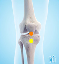 前十字靭帯損傷の膝の前側の痛み
