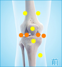 膝の前側の痛み（変形性膝関節症の合併症の痛み）