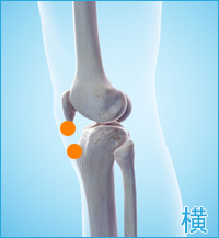 膝の横の痛み（内側側副靭帯損傷をかばった膝の痛み）