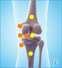 膝の裏側の痛み（内側側副靭帯損傷,内側半月板損傷）