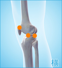 医療用の後十字靭帯用膝サポーター｜膝の横の痛み（後十字靭帯損傷の合併症）