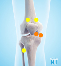 膝の前側の痛み（変形性膝関節症）