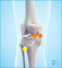膝の前側の痛み（変形性膝関節症）