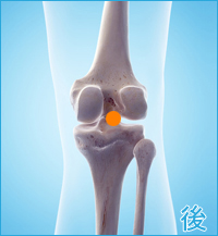 変形性膝関節症　膝の後ろ側の痛み