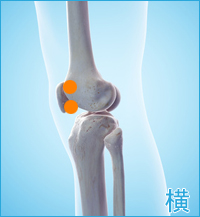 膝の横側の痛み（膝蓋骨裏の痛み,膝蓋骨の痛み,関節の痛み）