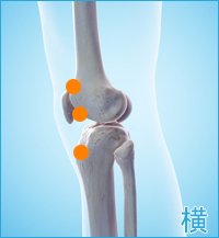 膝の横側の痛み（膝蓋靭帯の痛み,膝蓋骨の痛み,関節の痛み）