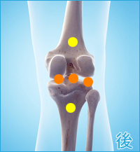 医療用の後十字靭帯用膝サポーター｜膝の後ろ側の痛み（後十字靭帯損傷の合併症）