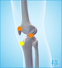 膝の痛み（膝蓋骨軟化症,オスグッドシュラッター病）
