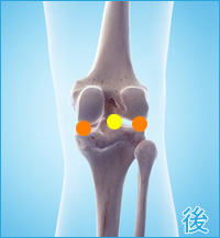 膝の後ろの痛み（離断性骨軟骨炎、膝蓋軟骨軟化症）