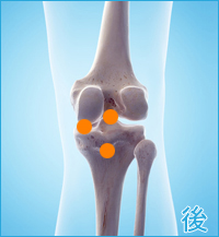 膝の後ろ側の痛み（変形性膝関節症）