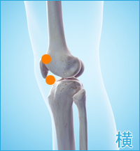 変形性膝関節症　膝の横側の痛み