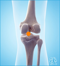 ベーカー嚢腫の膝の後ろ側の痛み