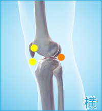 ベーカー嚢腫の膝の横の痛み
